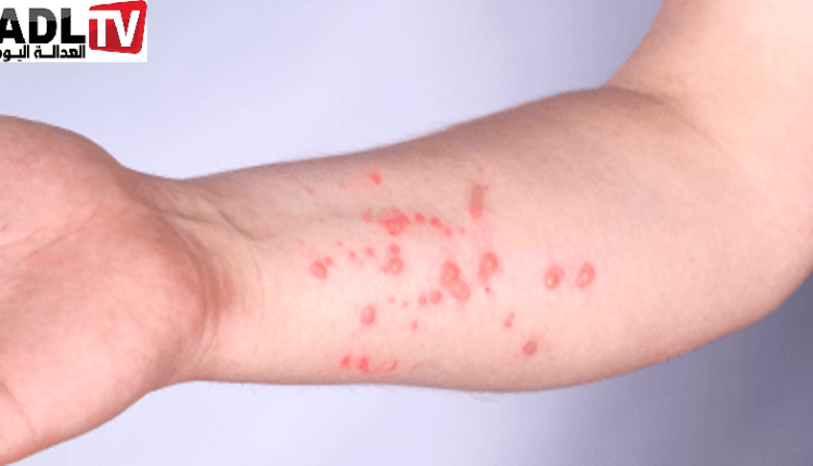 انتشار جدري القردة في إفريقيا