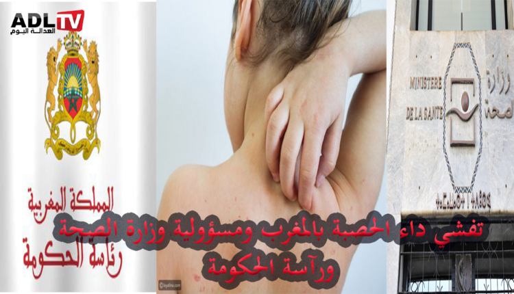 انتشار وباء "الحصبة" بالمغرب يسائل وزارة الصحة ورآسة الحكومة عن المسؤولية