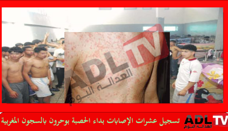 تسجيل عشرات الإصابات بداء الحصبة "بوحمرون" بمجموعة من المؤسسات السجنية المغربية