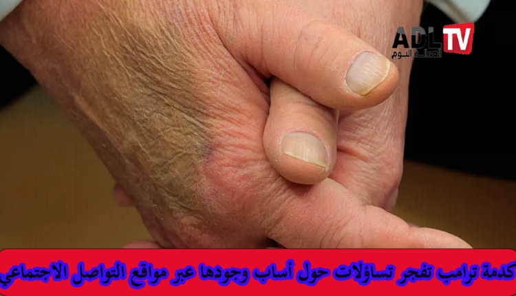 ظهور كدمة غامضة على يد "ترامب" خلال لقائه "ماكرون" تثير الجدل