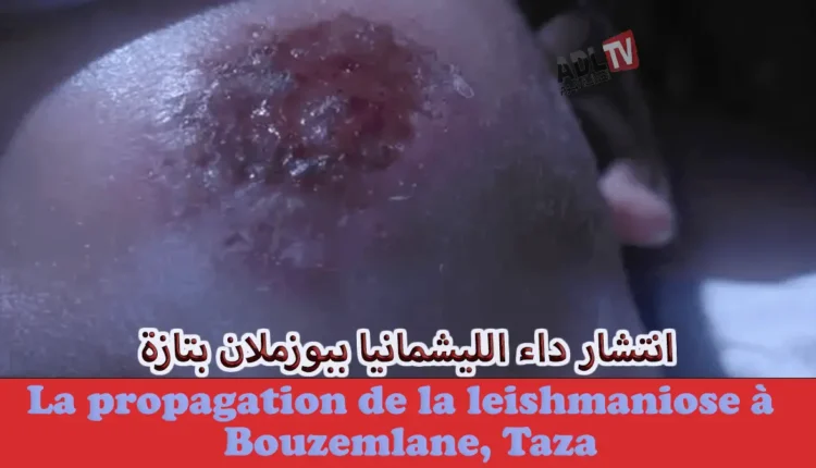 تازة: تفشي داء "اللشمانيا" الفتاك يهدد أطفال "بوزملان" ومخاوف من اتساع الغصابات